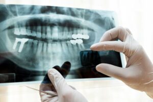 Funktionsdiagnostik, Röntgenbild von Kiefer und Zähnen
